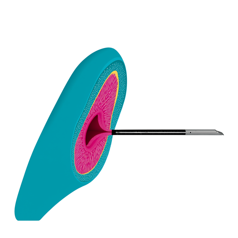 Determine Optimal Technique Visual Abstract